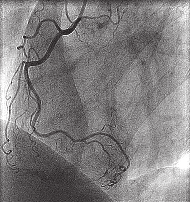 a b katheter ramus interventricularis anterior rami diagonales katheter ramus circumflexus ramus lateralis ramus interventricularis posterior figuur 3.