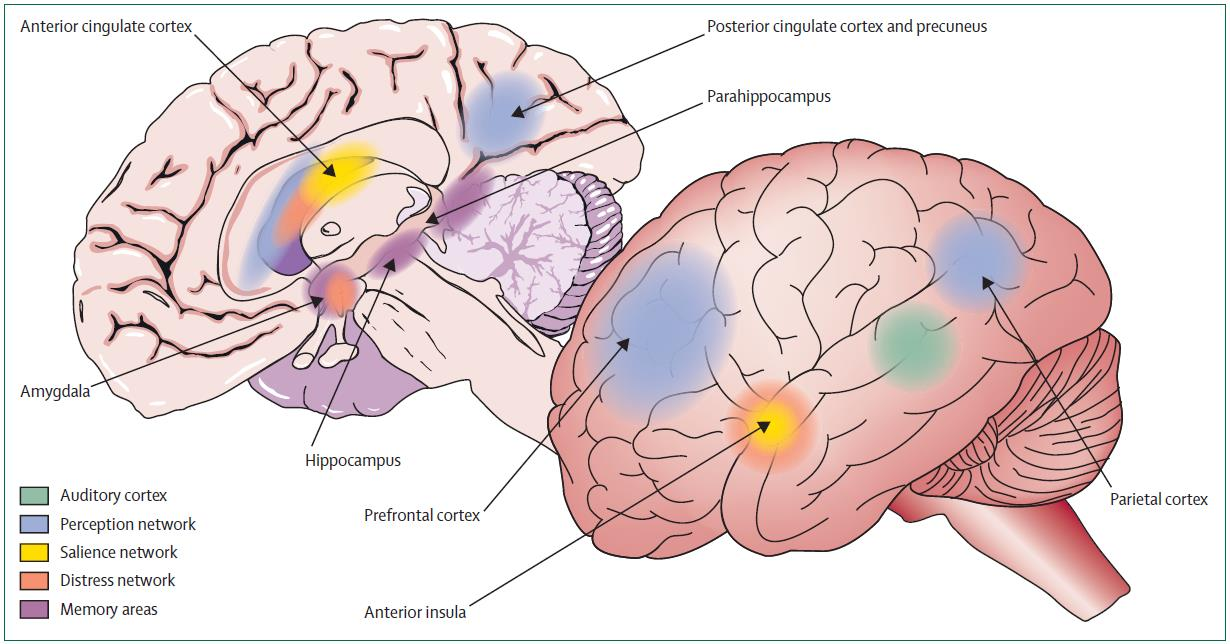 Het neurologisch beeld bij chronische tinnitus Langguth et al., 2013 Tinnitus ontstaat als een reactie op verminderd gehoor en/of invloeden van stress en overbelasting.