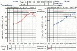 BERA drempelbepaling - Rechts Toonaudiometrie Spraakaudiometrie SAP test 10 db nhl Toonaudiometrie - Moeder Conclusies Casus -1- OAE: AD aanwezig 2 khz, AS afwezig BERA: AD normale drempel (2-4 khz!