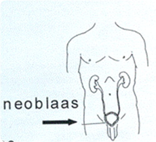 De voorkeursplaats van de uitgang van de urinepouch is in de navel of in de rechter helft van de onderbuik, onder uw rok of broek. Voor- en nadelen in vergelijking met andere omleidingvormen.