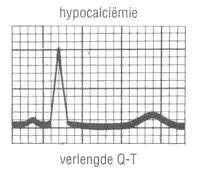 Hypocalciëmie ECG: Afname QRS-duur PR-Pjd kan verkort zijn