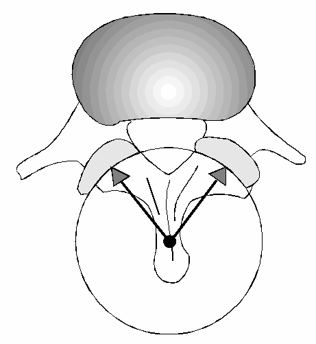 longitudinale as door het processus spinosus. Indien de rotatie-as daadwerkelijk daar zou liggen, zou een rotatiebeweging leiden tot het van elkaar afschuiven van de corpora.