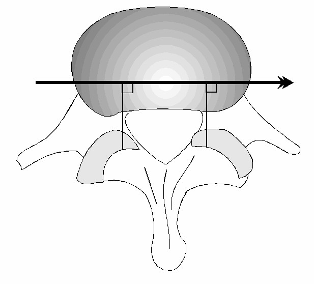 Figuur 3. a. uitgangspositie met de loodlijn in het kontaktpunt. b. linksom rotatie om een punt naast de loodlijn leidt tot separatie van de profielen. c.