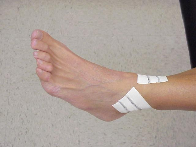 Inversion sprains-