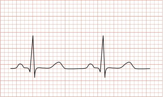 echocardiogram gemaakt. Er zijn veel dingen die bepalen hoe uw ECG eruit ziet. We willen nogmaals benadrukken dat er niets mis hoeft te zijn met uw hart als uw ECG niet helemaal normaal is.