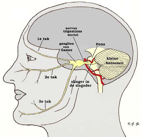 Inleiding Op het pijncentrum is met u besproken dat de pijnklachten van de aangezichtszenuw (nervus trigeminus) behandeld gaan worden met een behandeling van het ganglion van Gasser.