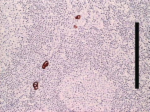 O ND ERZO EK b a c d e f g h FIGUUR Voorbeelden van foto s van tumorcellen in lymfklieren van patiënten, geopereerd wegens colorectaal carcinoom.