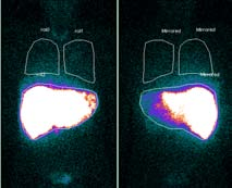 Voorbereiding: pre-sirs Angiografie hepatische vasculatuur anatomische varianten Embolisatie collaterale takken naar extrahepatisch ter voorkoming van