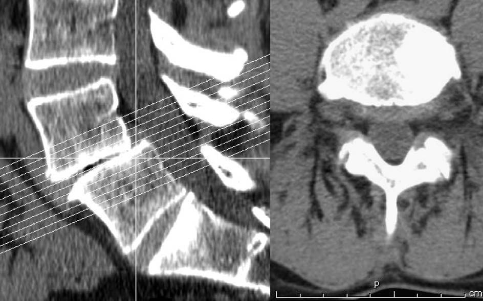 A B Figuur 1. A. Sagittale multi-slice CT-scanreconstructie en B. transversale opname op niveau L4-L5 van de lumbale wervelkolom bij patiënt 1.