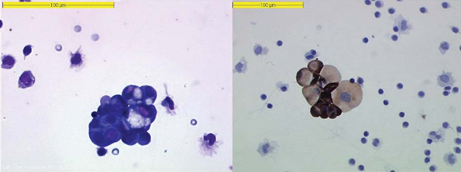 A B Figuur 2. Cytologisch beeld van de celrijke liquor van patiënt 1 (vergroting 400x). A. De may-grünwald-giemsakleuring laat een groepje epitheliale cellen zien met gevacuoliseerd cytoplasma. B. De immunohistochemische kleuring met anti-cytokeratine-7 laat positieve cellen zien die passen bij een adenocarcinoom.