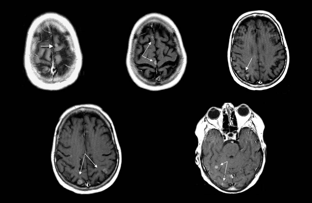 A B C D E Figuur 4. Transversale T1-gewogen MRI van het cerebrum met contrast van patiënte 2. Zichtbaar zijn leptomeningeale metastasen en enkele parenchymateuse metastasen (pijlen).