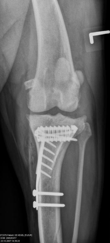 Op het rechter kniegewricht werden radiografisch geen abnormaliteiten aangetroffen. 9.1.4.