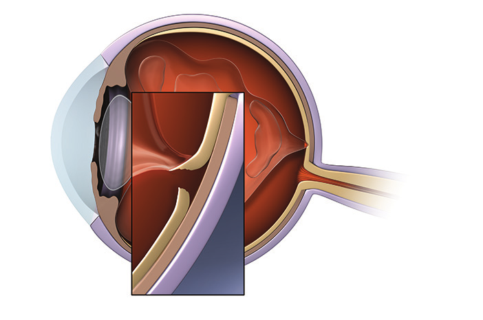 Het oog vertoont een aanhoudende verkleving van het glasvocht aan de macula vitreomaculaire tractie vitreomaculaire verkleving Deze gedeeltes van vitreomaculaire verkleving kunnen een trekkracht