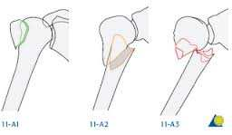Inleiding De arts of verpleegkundig specialist op de Spoedeisende Hulp (SEH) heeft u verteld dat uw bovenarm gebroken is (subcapitale humerus fractuur).