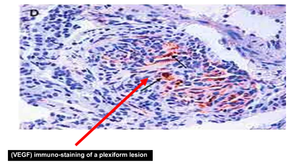 Plexiform Lesion 04-02- 14