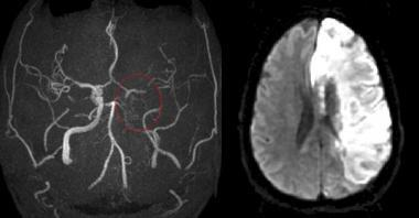 Kliniek ischemisch CVA Anterior circulatie Contralateraal sensorimotorisch hemibeeld