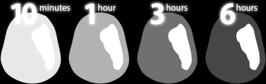 1/ Trombolyse - 2 miljoen neuronen/min Elke 15 min