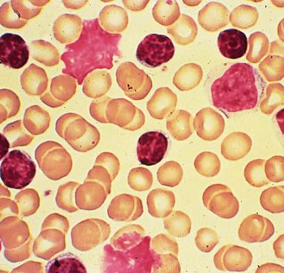 lymfocytose: > 5x10 9 /L met