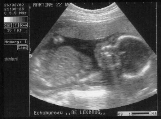 Opgave 3 Echoscopie In een ziekenhuis kan gebruik gemaakt worden van echoschopie om een ongeboren baby te bekijken.