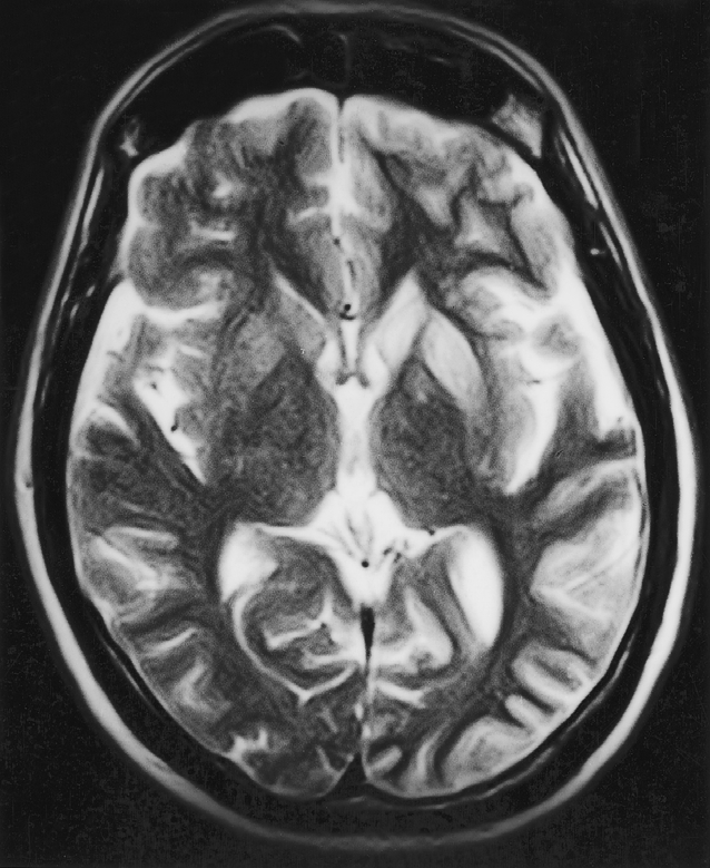 a nucleus caudatus putamen b pulvinar Afwijkingen op T 2 -gewogen MRI-opnamen bij (a) een patiënt met de klassieke vorm van de ziekte van Creutzfeldt-Jakob (CJD): hyperintensiteit in nucleus caudatus