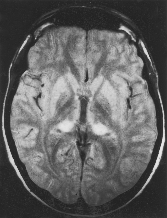 intensiteitsverandering van de cortex. de introductie van synthetisch groeihormoon in 1985 en door een nauwkeurige screening van donoren en verbeterde decontaminatie van donormateriaal).