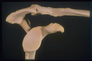 fig. 4.13 Kopnecrose fig. 4.14 Delta prothese Impingement van de schouder De term Impingement ( inklemming ) is 1972 geïntroduceerd door de orthopeed Charles Neer (74).