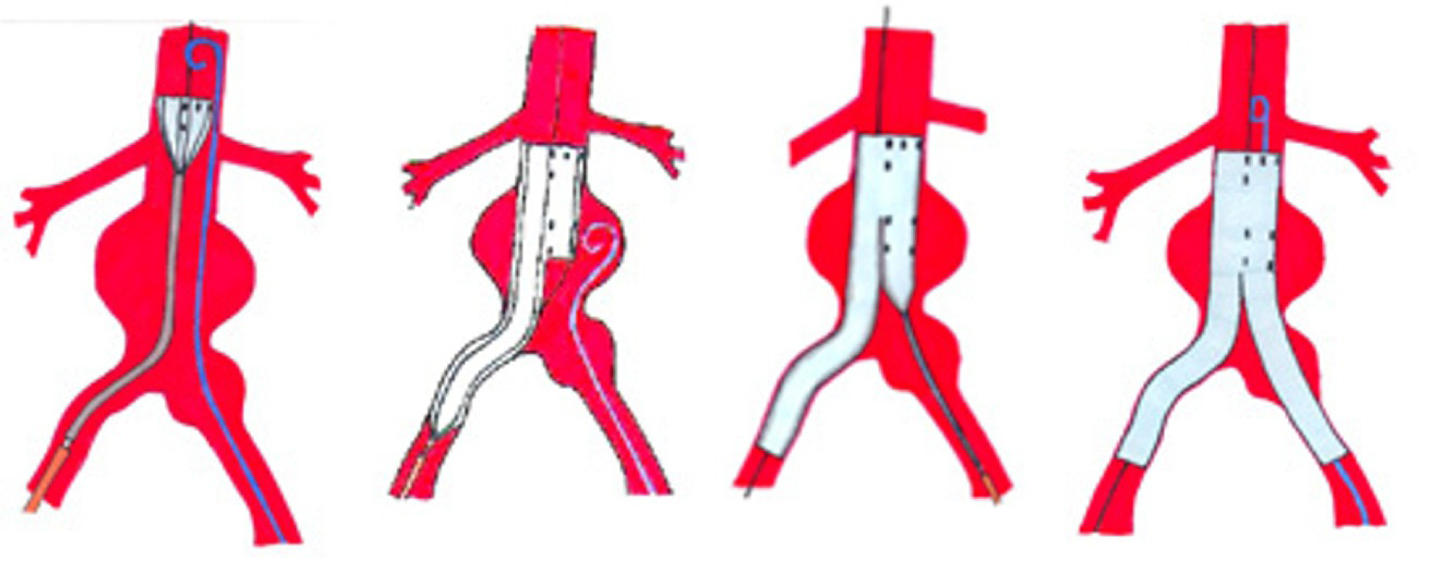 Wat is een endoprothese? De opname in het ziekenhuis De endovasculaire techniek om een aneuryma te behandelen is een relatief nieuwe techniek die veel minder ingrijpend is dan de klassieke ingreep.
