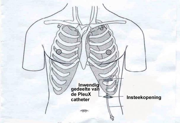 verbindingslang. De hechtingen mogen dan ook 10 dagen na het inbrengen verwijderd worden. De wijkverpleging die betrokken is bij de zorg mogen dat ook doen.