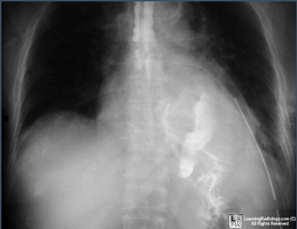 bij 14%) RX thorax: