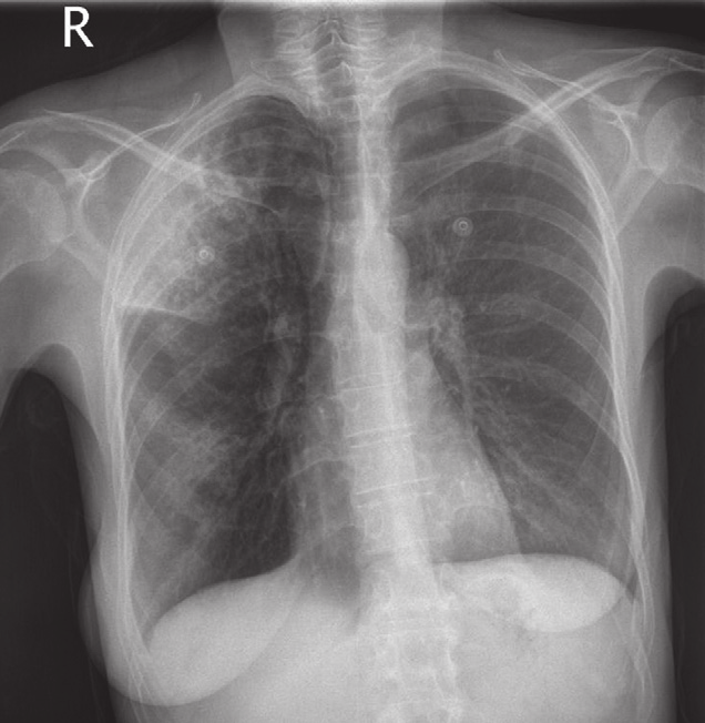 KLINISCHE PRAKTIJK infiltraat FIGUUR 1 Anterieur-posterieure thoraxröntgenopname van patiënt A, met infiltraten in de rechter boven- en onderkwab.
