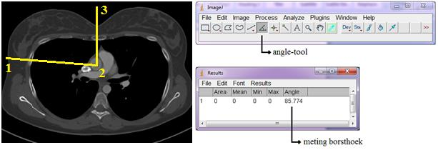 2.2.4 Meting borsthoeken De volledige beeldenset van de patiënt werd geladen in ImageJ. De meting werd uitgevoerd op de slice waarop de borsten zo lateraal mogelijk gelegen waren.