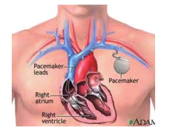 INFOBROCHURE IIPacemaker 9 Aan de zijde waar de pacemaker geplaatst zal worden, wordt eventueel het haar ter hoogte van de borststreek geschoren.