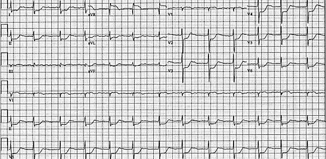 ECG