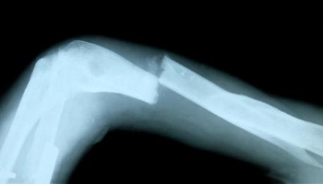 Fractuur risico post-tx Herstel PTH resistentie (corticaal bot) Nog bestaande renale osteodystrofie (en GFR na Tx) Scherpe daling BMD (DXA)