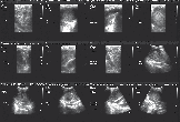 Voorbeelden van deze scans zijn een botscan of botscintigrafie, galliumscan en PET-scan (Positron Emissie Tomografie).
