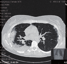 20 nederlands tijdschrift voor anesthesiologie september '08 case report Figuur 2: Concluderend in vergelijking met CT-thorax van 23 oktober diffuus verspreide alveolaire consolidaties in beide