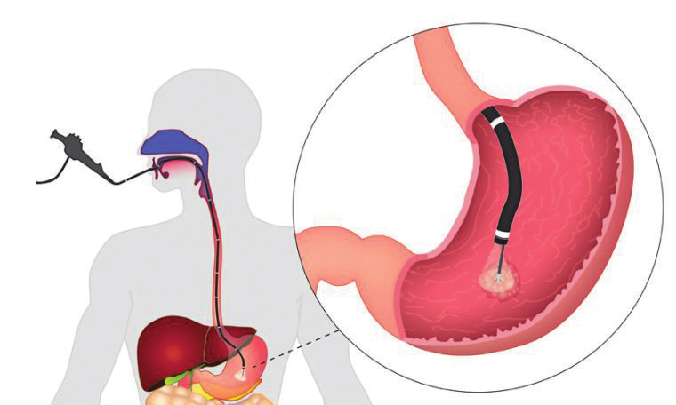 Wat is een gastroscopie? Een gastroscopie is een onderzoek waarbij de binnenzijde van de slokdarm, de maag en de twaalfvingerige darm onderzocht worden.
