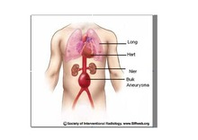 Patiënteninformatie Aneurysma Wat is een aneurysma? Een aneurysma is een plaatselijke verwijding van een slagader. Een aneurysma ontstaat ongemerkt en groeit geleidelijk.