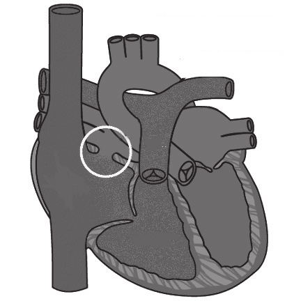 Het sluiten van een PFO Uw arts heeft vastgesteld dat u een opening hebt in het tussenschot van uw hart. Deze afwijking heet een PFO (Patent Foramen Ovale).