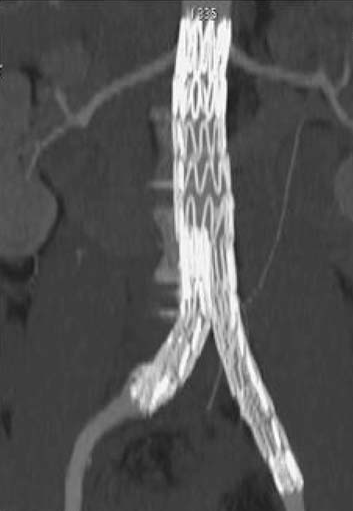 Er zijn echter een drietal voorwaarden vooraleer men deze ingreep kan uitvoeren. Vooreerst moet er nog 10-15mm normale aorta aanwezig zijn onder de renale arteriën ter vasthechting van de stent.