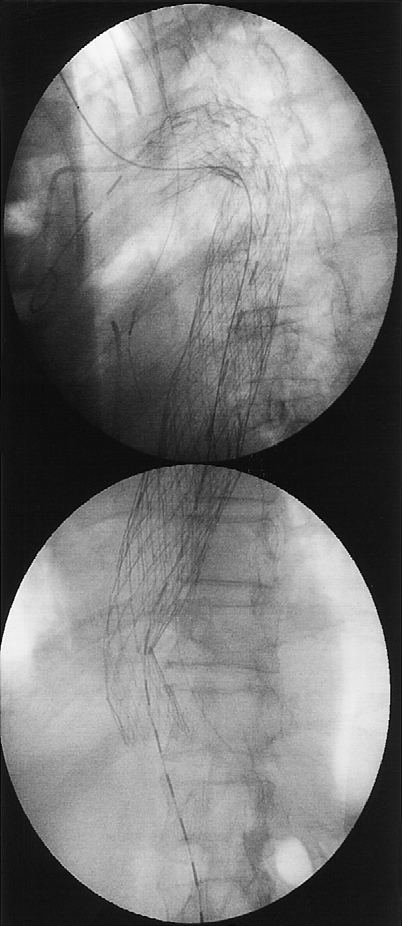 1. Patiënt A, 45 -anterieur-posterieuropnamen: (a) magnetische-resonantieangiografie (MRA) toont 3