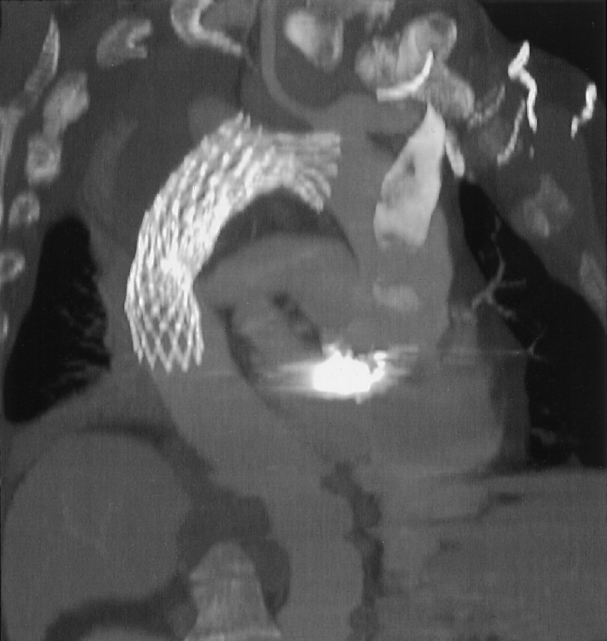 cava superior aorta pars ascendens long milt wervel aortaklep b lekkage aortaboog sternumhechtingen c prothese aortawand figuur 2.