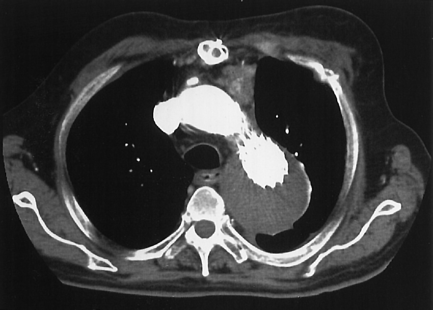 subclavia is opgenomen in het aneurysma; (b) na endovasculaire plaatsing van 2 overlappende stent-buisprothesen toont een 45