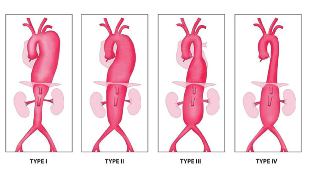 aneurysma (SRA). De groep van JRA en SRA aneurysmata noemt men pararenale aneurysmata (PAA). Een aneurysma kan ook in de aorta in de borstkas ontstaan (thoracaal aneurysma, TAA).