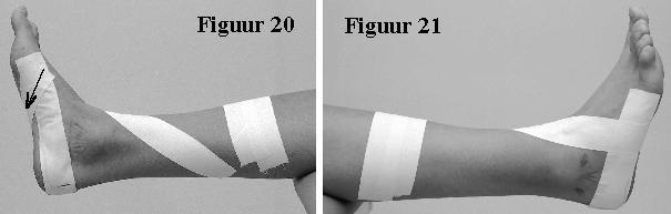 De werkstroken De werkstroken hebben als functie het stabiliseren van de voet zelf. De eerste stook wordt aangebracht vanaf de binnenzijde van de voet, zo dicht mogelijk bij de grote teen.