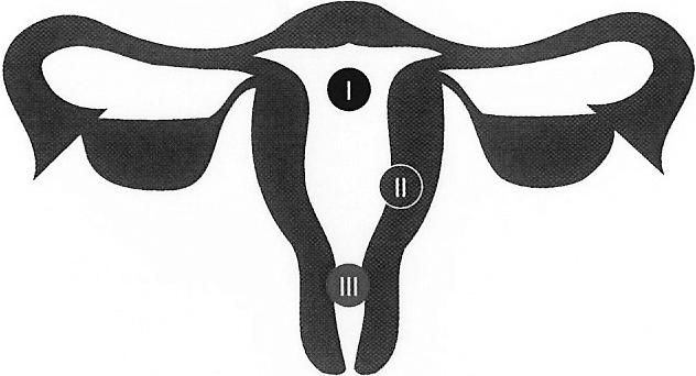 de uterus voor prostaglandine contractiliteit van het myometrium Loslating van het embryo Verweking en dilatatie cervix Bijwerkingen Misselijkheid Braken