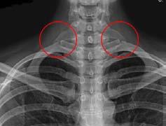 Onderzoeken bij NTOS In het diagnostisch proces maken we gebruik van verschillende onderzoeken: Röntgenfoto bovenste deel borstkas (afbeelding 5) Om eventuele afwijkingen van sleutelbeen, eerste rib