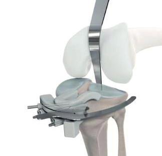 operatiekamer Het doel van het implanteren van een knieprothese is: Patiënt Specifiek Instrumentarium (PSI) Het verminderen van pijn en verbeteren van