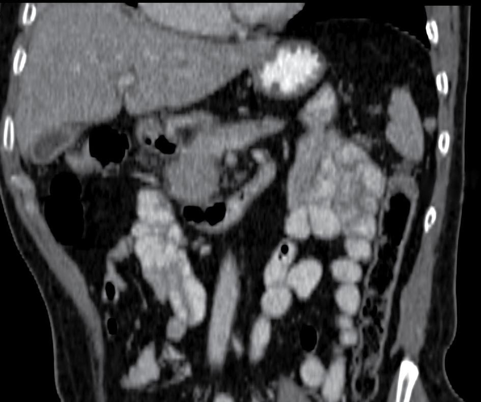 lever solide ruimteinnemend proces pancreascorpus maag colon galblaas aorta duodenum dunne darm FIGUUR 1 Een sagittale CT-scan van het abdomen van patiënt A toont een hypodens solide proces in de