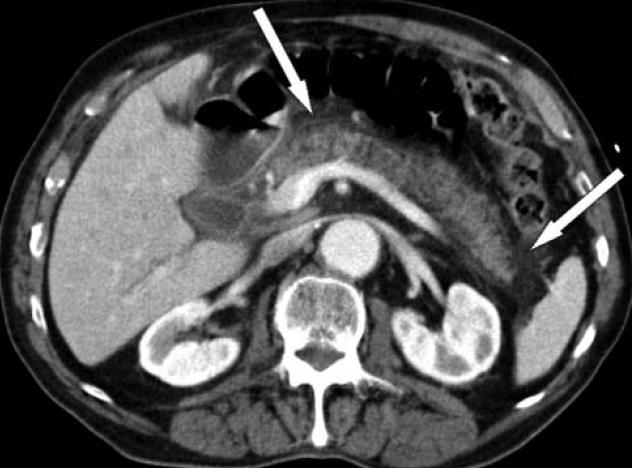 Acute pancreatitis ± 90% ± 10% Interstitial oedematous pancreatitis